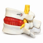 Prolapsed Intervertebral Disc